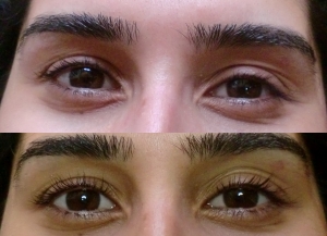 wimpernlifting