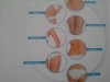 kryolipolyse-