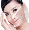 sensitive-skin--rosacea-couporose-therapie--med-kosmetik-90-min-
