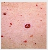 hochfrequenz---rws---therapie-behandlungen