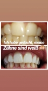 zahnbleaching-