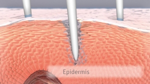 microneedling-kosmetikbehandlung-chemnitz-