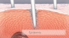 microneedling-kosmetikbehandlung-chemnitz-