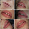 lippen-mit-hyaluron-pen
